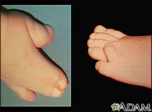 Repair of webbed fingers or toes Information