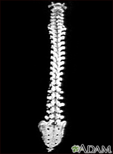 X ray dorso lumbar spine A/P and lateral views showing Kypho