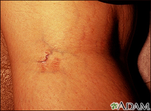 How To Get Rid Of Stretch Marks