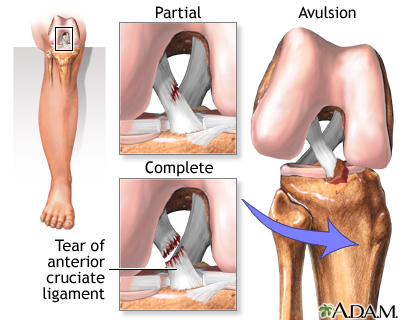 Management of ACL rupture