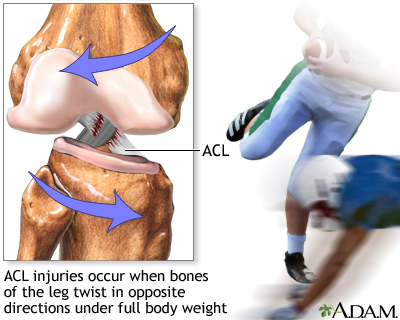 Anterior Cruciate Ligament (ACL) Tears (for Parents)