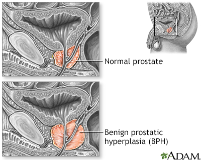 Enlarged prostate Information Mount Sinai New York