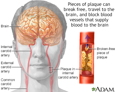 pressure on carotid artery