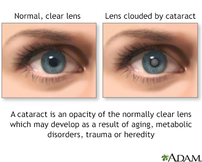 eye cataract without