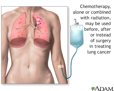 Lung cancer - chemotherapy treatment - Illustration Thumbnail
                      