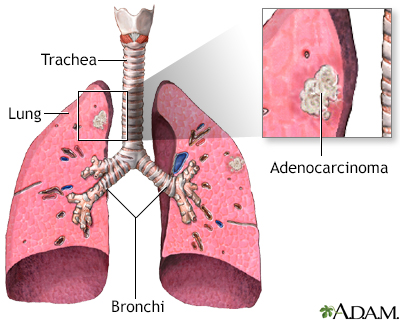 Adenocarcinoma