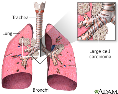 Large cell carcinoma - Illustration Thumbnail              