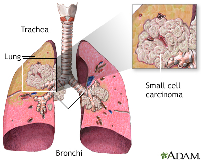 Sarcoma cancer of the lungs. Cum scapi de viermi viermi