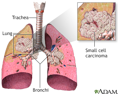 Small cell carcinoma - Illustration Thumbnail
              