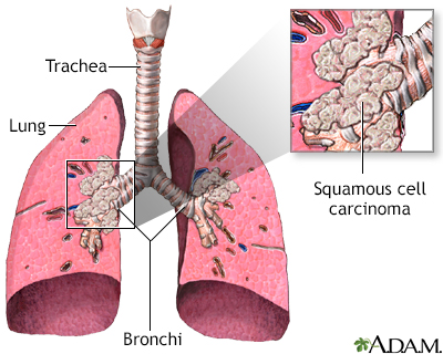 aggressive cancer in lungs