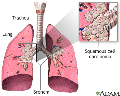 Squamous Cell Carcinoma Lung