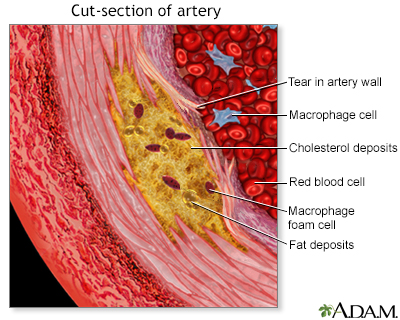 how does a fatty streak happen in arteries