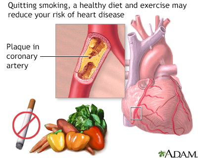 Prevention of heart disease - Illustration Thumbnail              