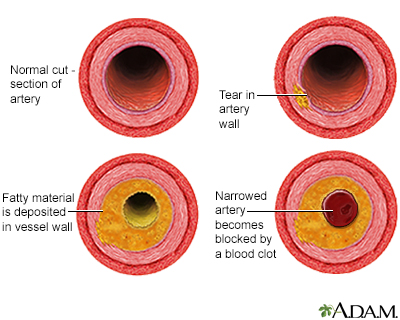 Developmental process of atherosclerosis - Illustration Thumbnail
              