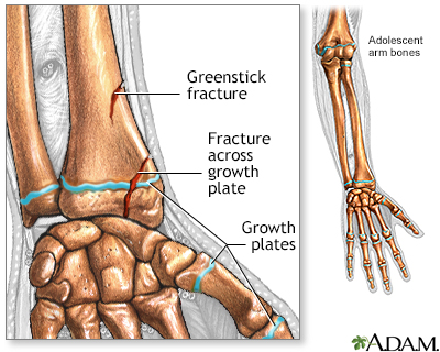 Fractures across a growth plate - Illustration Thumbnail
                      