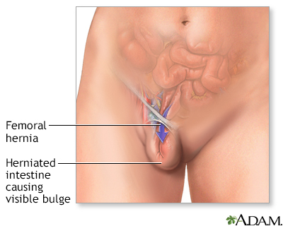 Femoral hernia Information