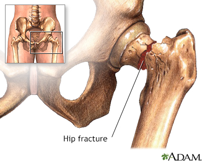 Hip fracture - Illustration Thumbnail