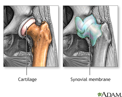 Osteoarthritis vs. rheumatoid arthritis - Illustration Thumbnail              