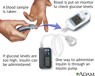 Glucose test - Illustration Thumbnail              