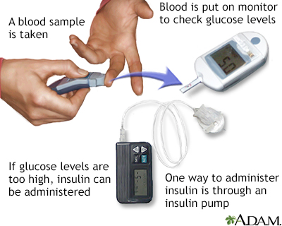 Glucose test - Illustration Thumbnail							