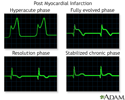 Post myocardial infarction ECG wave tracings - Illustration Thumbnail							