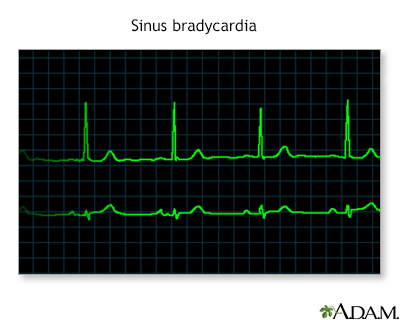 Bradycardia - Illustration Thumbnail              