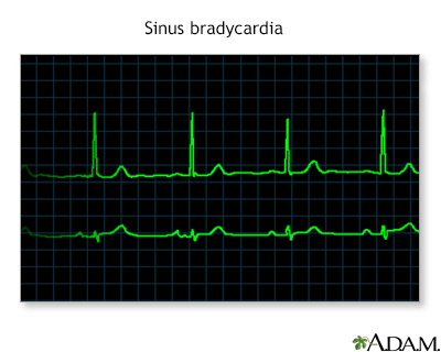 Bradycardia - Illustration Thumbnail
              