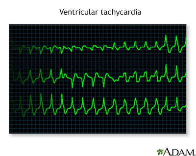Ventricular tachycardia - Illustration Thumbnail              