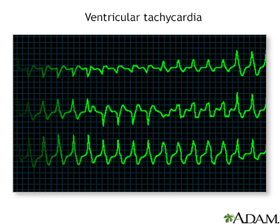 Ventricular tachycardia - Illustration Thumbnail
              