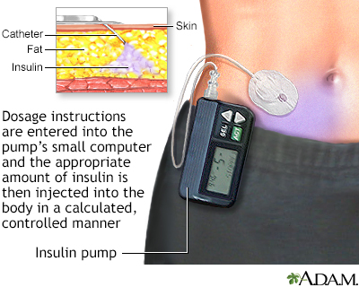 Insulin pumps Information