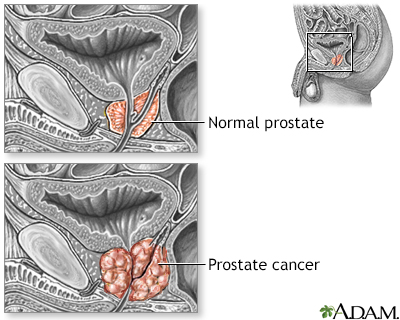 prostate cancer symptoms ncbi