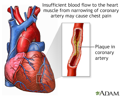 Coronary Artery Spasm - Symptoms and Causes