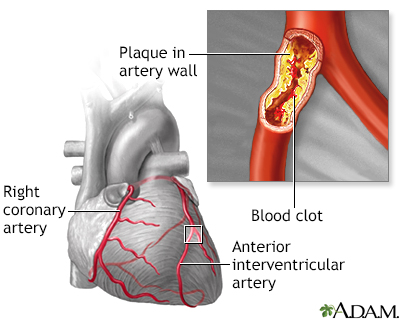 Artery atherosclerosis coronary Atherosclerosis