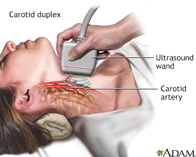 carotid artery ultrasound