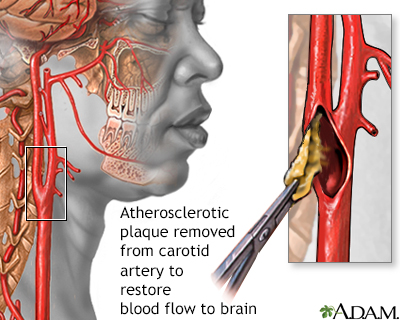 Endarterectomy - Illustration Thumbnail