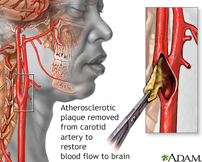 Endarterectomy - Illustration Thumbnail              