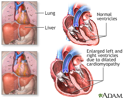 Alcoholic cardiomyopathy - Illustration Thumbnail
              