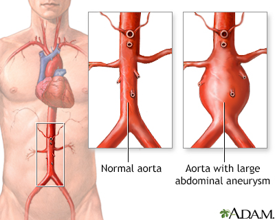 Aortic aneurysm - Illustration Thumbnail
                      