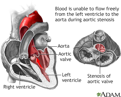 Aortic stenosis