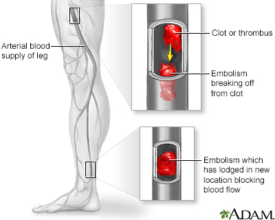 Illustrations of a typical clot configuration within the flow