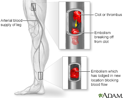 Illustrations of a typical clot configuration within the flow field and