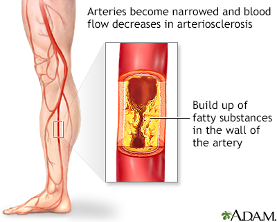 Arteriosclerosis of the extremities - Illustration Thumbnail
              