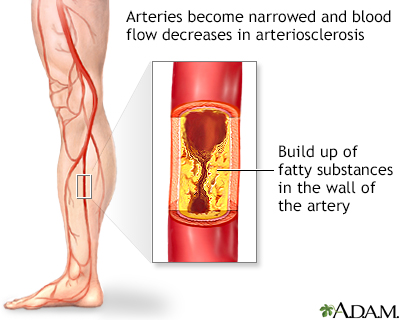 Arteriosclerosis of the extremities - Illustration Thumbnail
                      