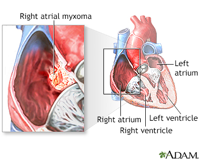 Atrial myxoma Information | Mount Sinai - New York