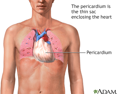 Cardiac tamponade Information