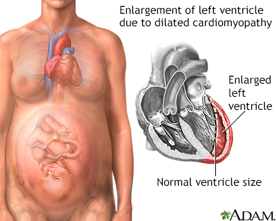 Dilated hotsell cardiomyopathy symptoms