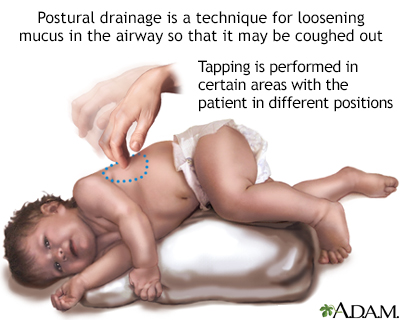 Postural drainage - Illustration Thumbnail
              