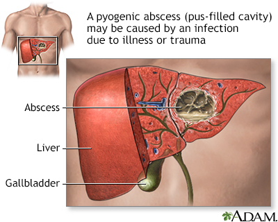 Pyogenic abscess