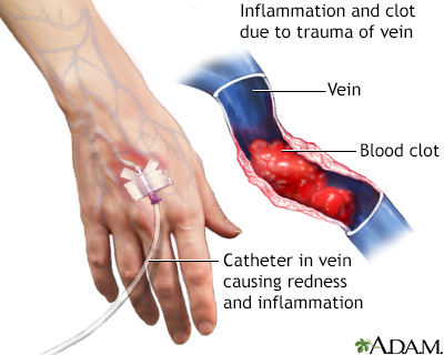 Phlebitis & DVT: What you Need to Know - Vein Clinic in Kansas City