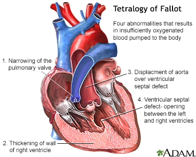 Tetralogy of Fallot - Illustration Thumbnail
                      